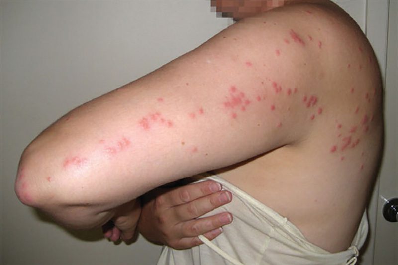bedbug_1